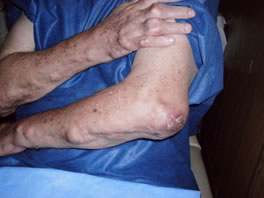 Artritis Severa en el Codo